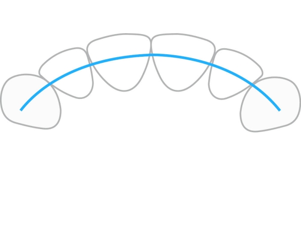 ProTain™, digitale retainer, bovenkaak